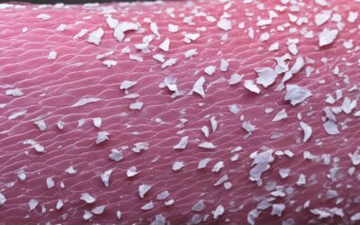 Estratégias para lidar com a pele áspera e descamativa