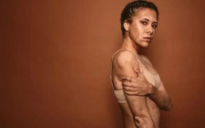 Clínica bioestimulador glúteo campo limpo paulista: transforme seu corpo agora