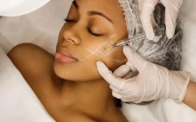 Bioestimulador facial com médica dermatologista jundiaí: realce sua beleza